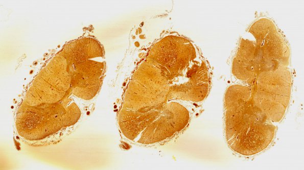 7C Tract Degeneration (Case 2) Biels whole mount