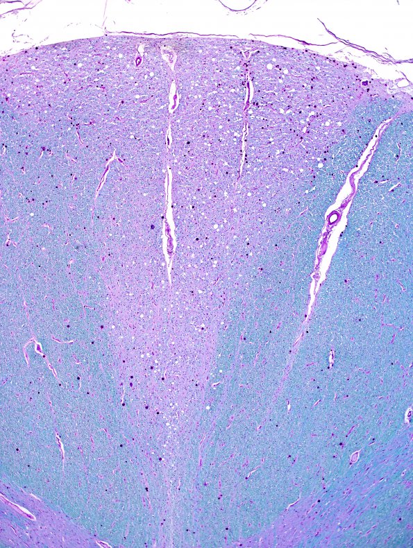 8B2 Ascending tract degeneration, dorsal columns due to caudal myelitis (Case 11) LFB-PAS 2