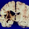 9A1 Infarct, remote (4 years), (Case 8) 13