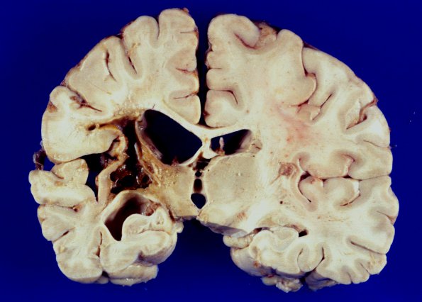 9A1 Infarct, remote (4 years), (Case 8) 13