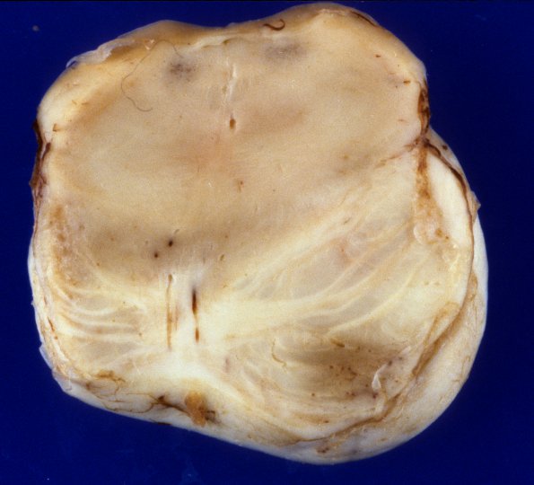 9A3 Infarct, remote (4 years), (Case 8) 10