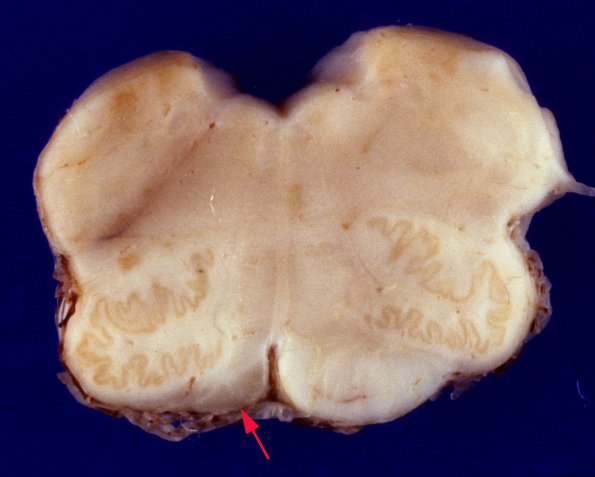 9A5 Infarct, remote (4 years), (Case 8) 9