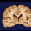 1A Transneuronal degeneration LGN, secondary to congenital glaucoma, mostly unilateral damage (Case 2)