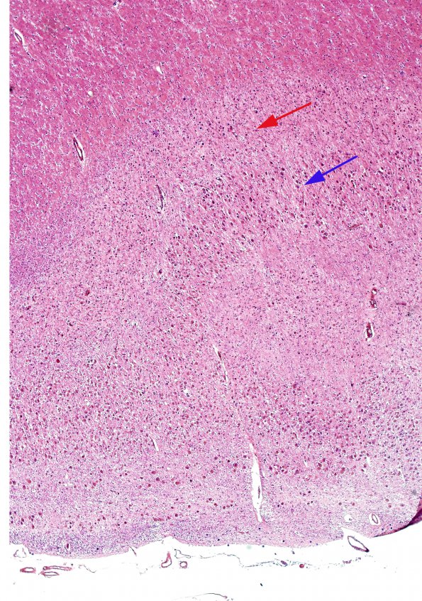 2A1 Transneuronal degeneration (LGN) (Case 2) layers 1-6 H&E