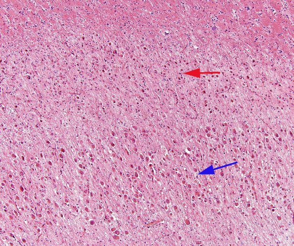 2A2 Transneuronal degeneration (LGN) (Case 2) layers 5&6top H&E 3