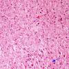 2A3 Transneuronal degeneration (LGN) (Case 2) layers 5&6 top H&E 1