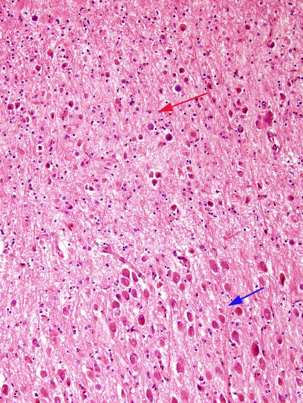 2A3 Transneuronal degeneration (LGN) (Case 2) layers 5&6 top H&E 1