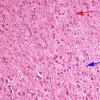 2A4 Transneuronal degeneration (LGN) (Case 2) layers 5&6top H&E 2