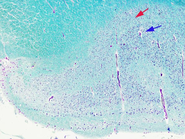 2B1 Transneuronal degeneration LGN 7