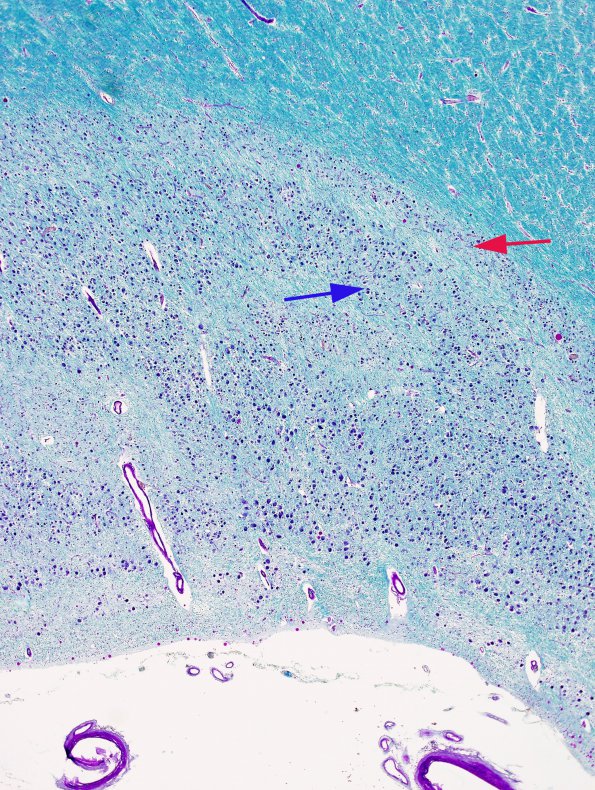 2B2 Transneuronal degeneration (LGN) (Case 2) layers 1-6 LFB-PAS 1