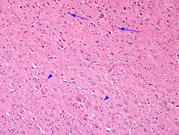 3B1 Transneuronal Degeneration LGN (Case 4), childhood eye injury partial (H&E) 3