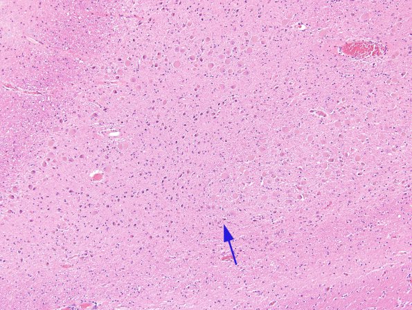 3B2 Transneuronal Degeneration, patchy, LGN (Case 4), childhood eye injury partial (H&E) 3