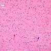 3B3 Transneuronal Degeneration, patchy, LGN (Case 4), childhood eye injury partial (H&E) 2