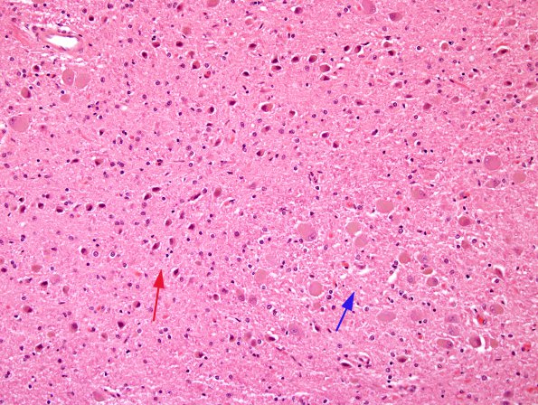 3B3 Transneuronal Degeneration, patchy, LGN (Case 4), childhood eye injury partial (H&E) 2