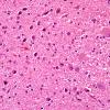 3B4 Transneuronal Degeneration, patchy, LGN (Case 4), childhood eye injury partial (H&E) 6