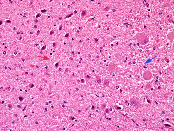 3B4 Transneuronal Degeneration, patchy, LGN (Case 4), childhood eye injury partial (H&E) 6