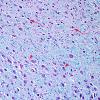 3C Transneuronal Degeneration LGN (Case 4), childhood eye injury partial (LFB-PAS)