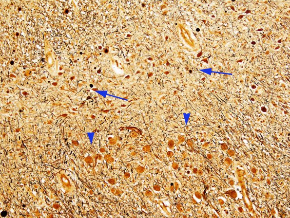 3D Transneuronal Degeneration LGN (Case 4), childhood eye injury partial (Bielschowsky)