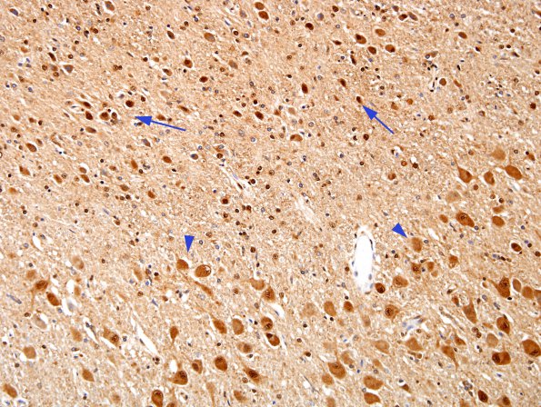 3E Transneuronal Degeneration LGN (Case 4), childhood eye injury partial (Ubiquitin)