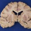 5A1 LGN, transneuronal degeneration, orthograde (Case 5) Gross_3 copy