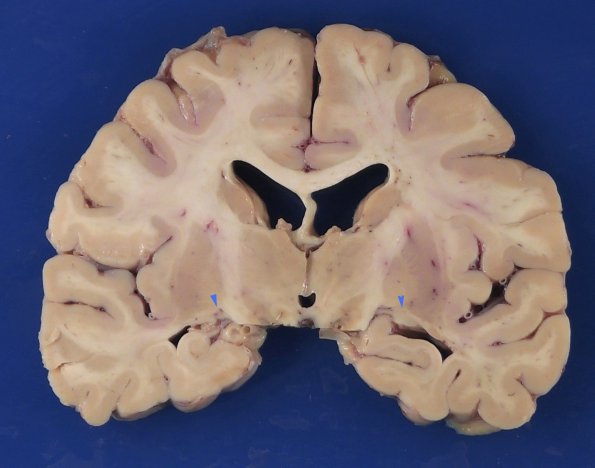 5A1 LGN, transneuronal degeneration, orthograde (Case 5) Gross_3 copy