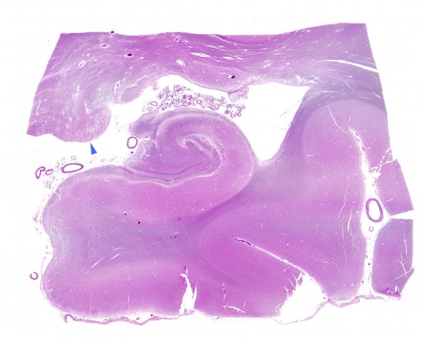 5B1 LGN, transneuronal degeneration, orthograde (Case 5) N3 WM 2 copy