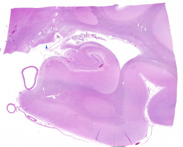 5D1 LGN, right, transneuronal degeneration, orthograde (Case 5) N21 WM 2 copy