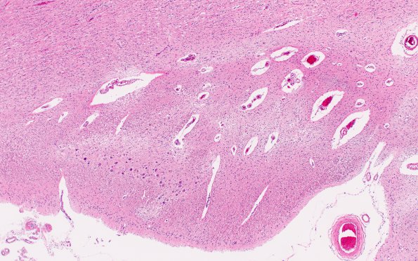 5D2 LGN, right, transneuronal degeneration, orthograde (Case 5) N21 2X 2