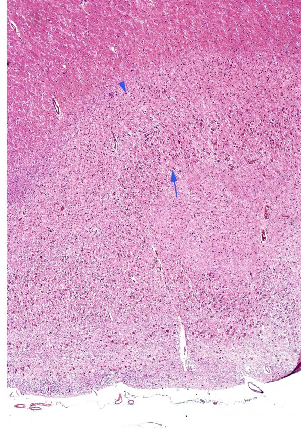 6A1 Transneuronal degeneration (LGN) (Case 6) layers 1-6 H&E copy