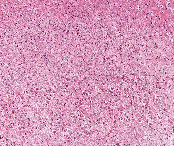 6A2 Transneuronal degeneration (LGN) (Case 6) layers 5&6top H&E 3