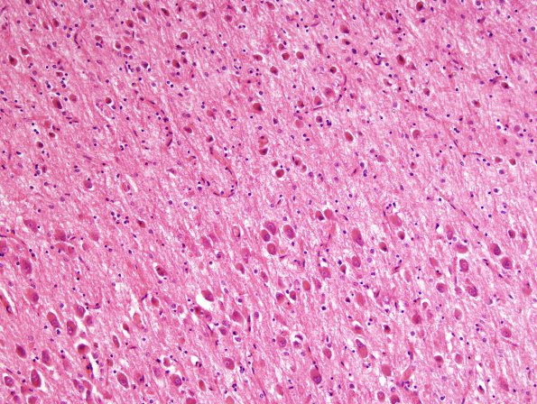 6A3 Transneuronal degeneration (LGN) (Case 6) layers 5&6top H&E 2