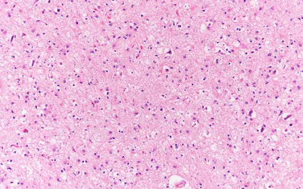 7A2 Transneuronal DM retinopathy (Case 7) N3 LGN H&E 20X