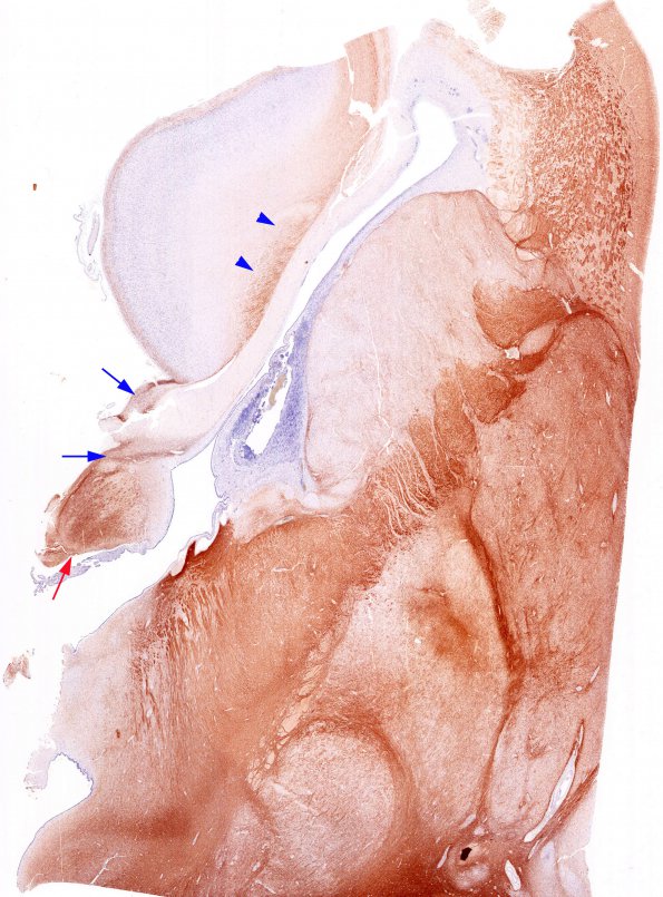 10A3 Agenesis of Corpus Callosum in hyperglycinemia (Case 10) N11 NF
