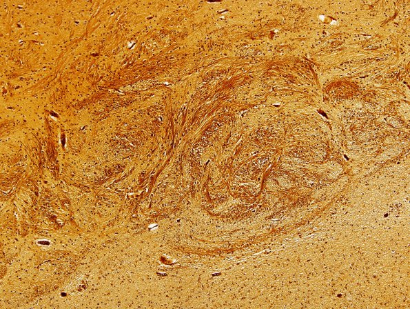 12B4 Agenesis Corpus Callosum, Probst bundles (Case 12) N13 Biels 10X