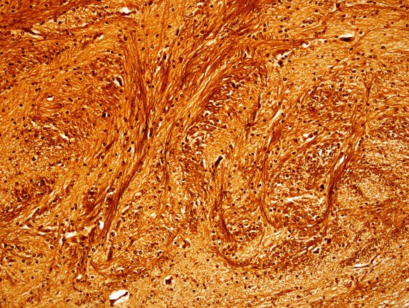 12B5 Agenesis Corpus Callosum, Probst bundles (Case 12) N13 Biels 20X