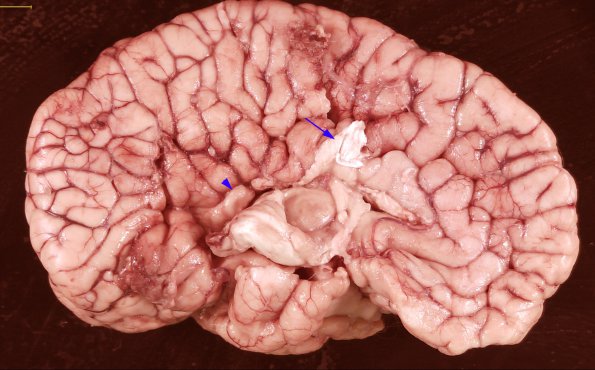 13 Agenesis Corpus Callosum (also Arnold-Chiari malformation) (Case 13) 