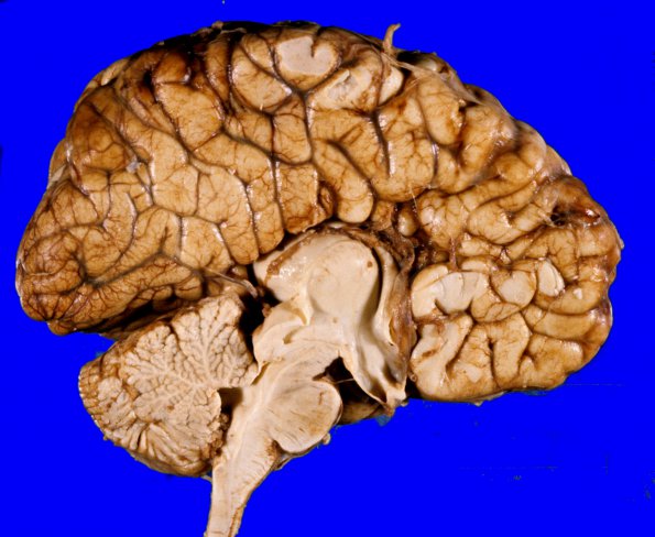 1A1 Agenesis Corpus Callosum (Case 1) 1