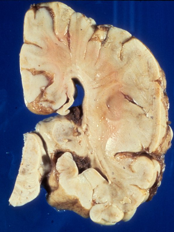 1A2 Agenesis Corpus Callosum (Case 1) 2