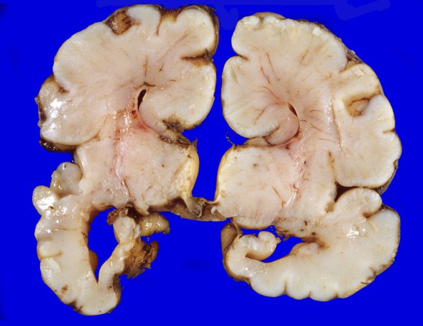 2A1 Agenesis Corpus Callosum (Case 2) 2