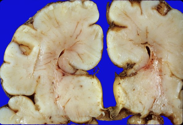 2A2 Agenesis Corpus Callosum (Case 2) 1