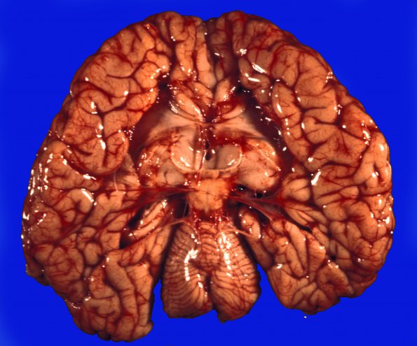 3A1 Agenesis Corpus Callosum (Case 3) 1