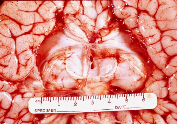 3A2 Agenesis Corpus Callosum (Case 3) 2