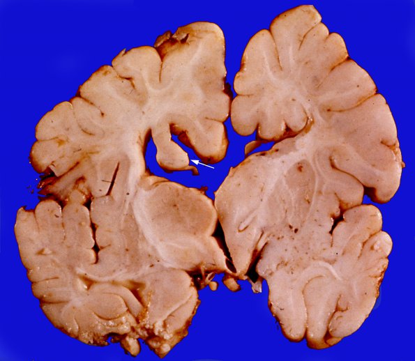 3A3 Agenesis Corpus Callosum (Case 3) 3