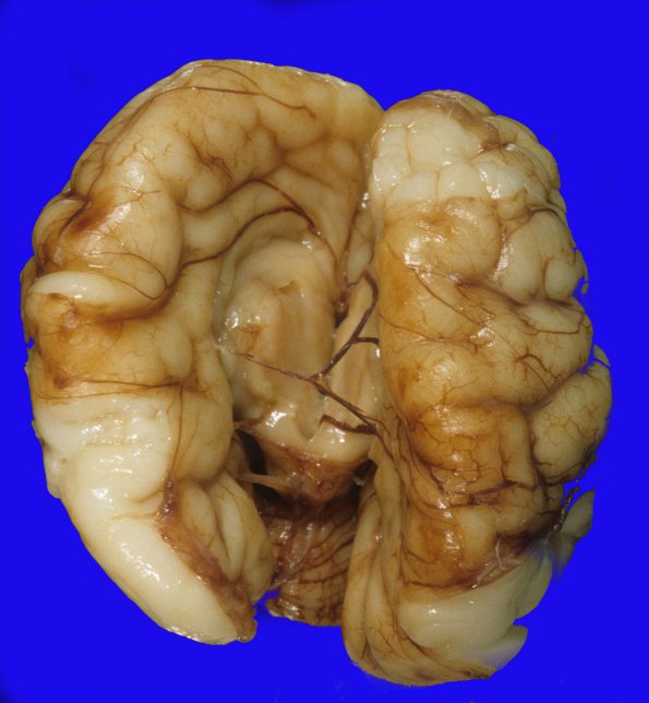 4 Agenesis, corpus callosum (Case 4)