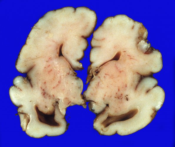 5A1 Agenesis corpus callosum (Case 5) 2