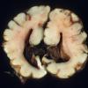 5A3 Agenesis corpus callosum (Case 5)