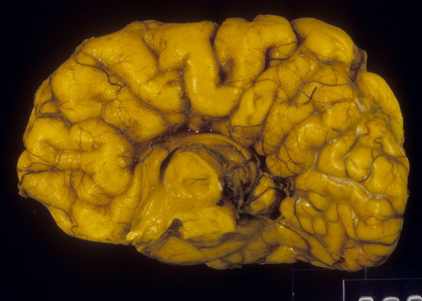 6A1 Agenesis, cor;pus callosum (Case 6) 1