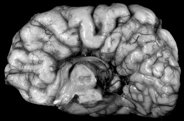 6A2 Agenesis, cor;pus callosum (Case 6) B&W conversion Bouin's 1