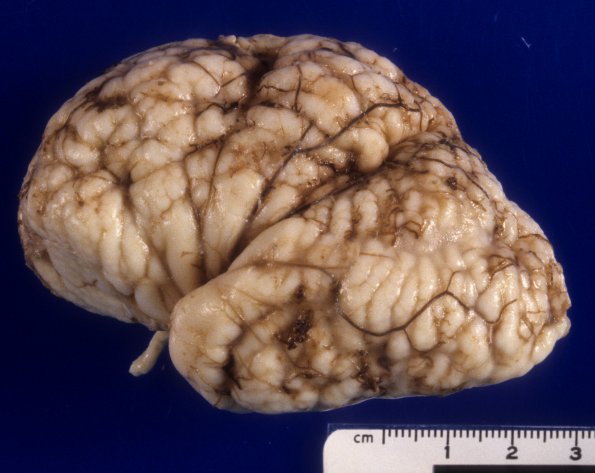 7A1 Agenesis corpus callosum, partial, polymicrogyria (Case 7) A1