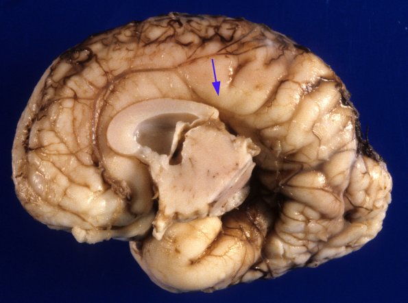 7A2 Agenesis corpus callosum, partial, polymicrogyria (Case 7) 1A